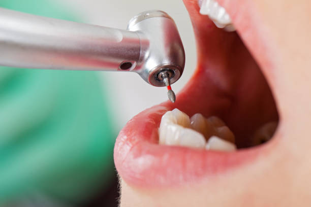Best Emergency Treatment for Dental Infections or Abscesses in Fayetteville, TN